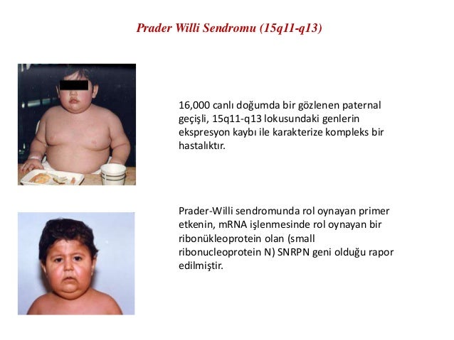 Prader Willi Sendromu nedir Prader Willi Sendromu nedir